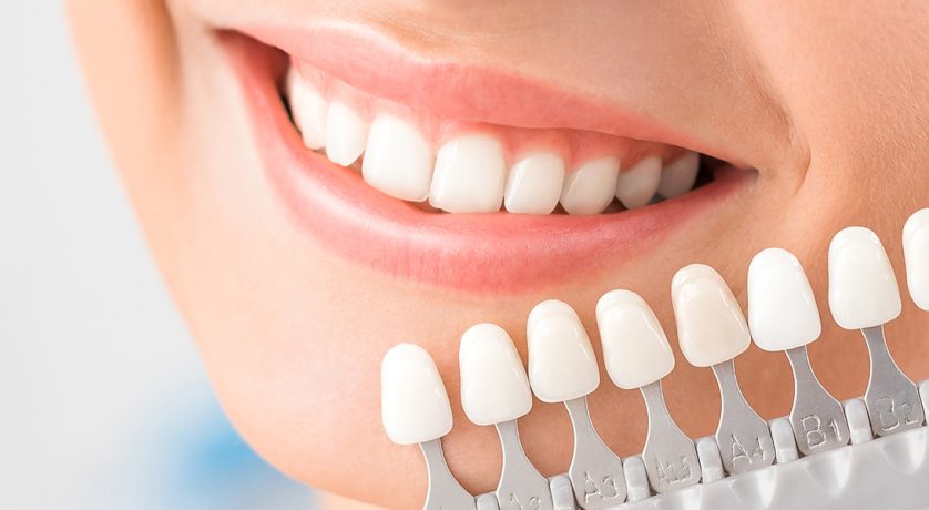 The Role of Dental Veneers in Enhancing Smile Aesthetics