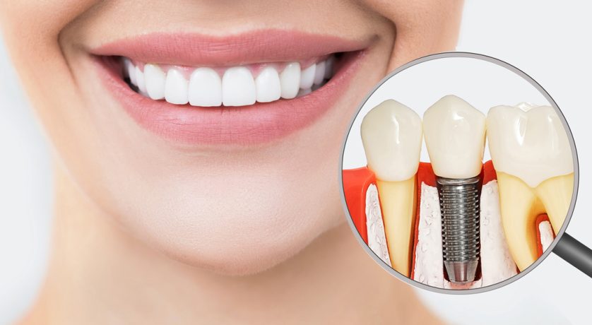 Can Dental Implants Fix a Missing Tooth Forever? What to Consider