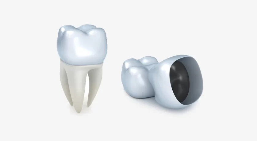 Dental Crowns in Cibolo, TX: 5 Signs You May Need One